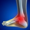Anterior Ankle Impingement